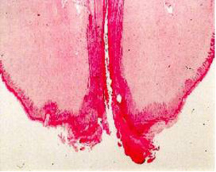 teat end showing hyperkeratosis
